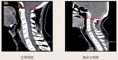 臨滄市中醫(yī)醫(yī)院外一科成功治愈顱底凹陷癥一例